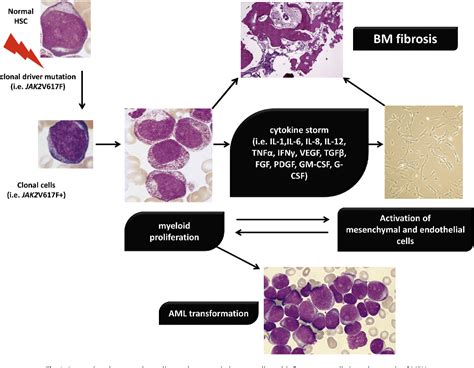 Inflammation And Myeloproliferative Neoplasms Semantic Scholar