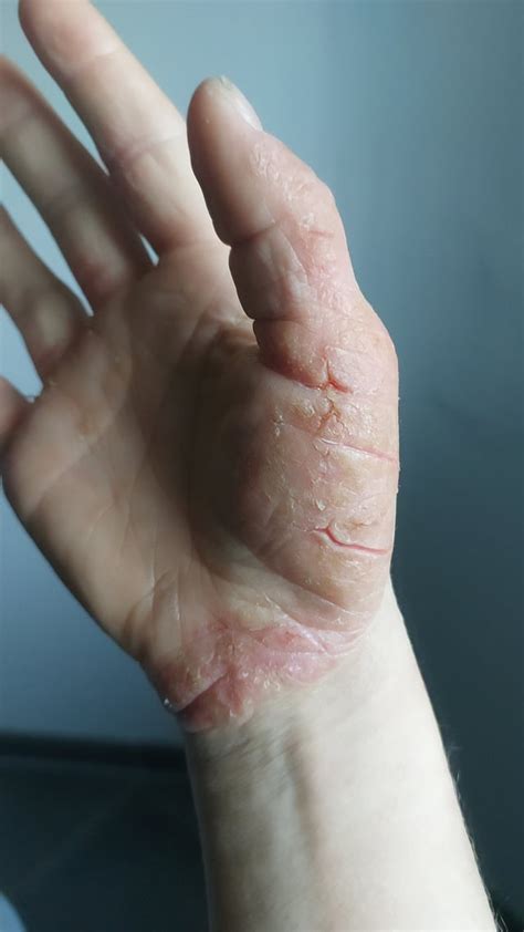 How Do You Handle Torn Skin It Hurts So Much And Doesnt Seem To Heal