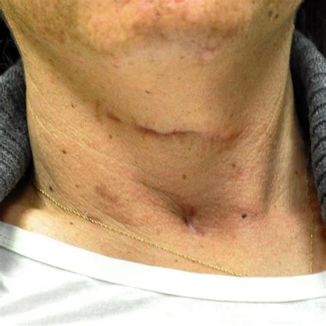 Scar After Neck Lift » Facelift: Info, Prices, Photos, Reviews, Q&A