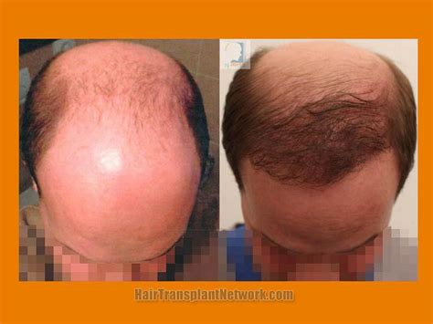 Dr Patrick Mwamba Hair Transplant Procedure Before And After Result Images With 2800 Fue And