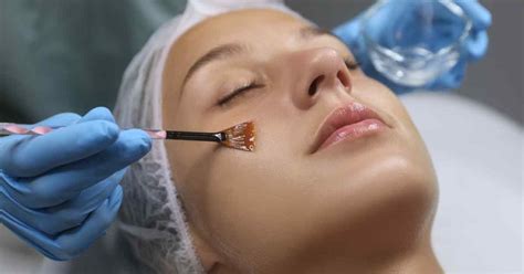 pelajari manfaat jenis  proses chemical peeling wajah