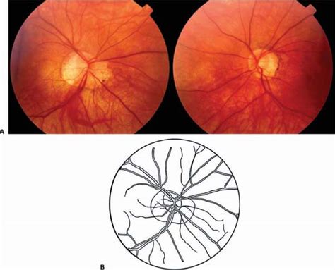 Optic Disc Pallor | Ento Key