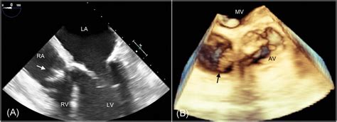 Preoperative Transesophageal Echocardiography A Four‐chamber View Download Scientific