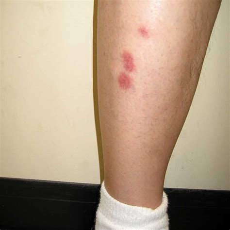 What Do Bed Bug Bites Look Like Pictures Tips Nextgen Pest Solutions