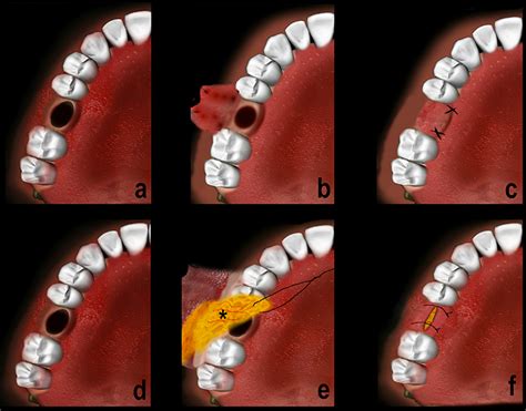 Management Of The Oroantral Fistula Intechopen