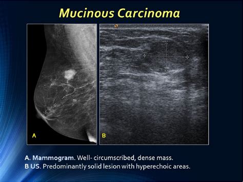 Well Circumscribed Breast Carcinoma Keys To Face The Challenge Of