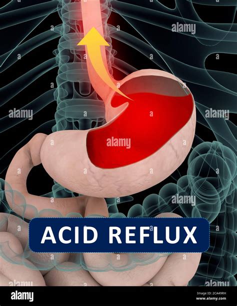 Acid Reflux Gerd Gastroesophageal Reflux Disease Stomach And