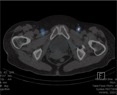 Update On Sentinel Lymph Node Biopsy For Early Stage Vulvar Cancer Gynecologic Oncology