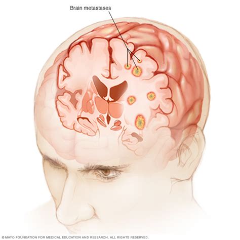 Brain metastases Disease Reference Guide - Drugs.com