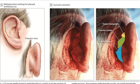 Figure 1 From Hybrid Cartilage Modifying Otoplasty Technique And