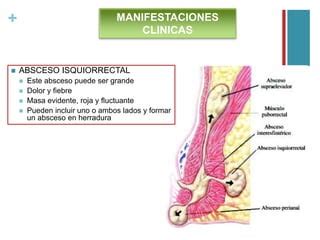 Abscesos Fistulas Anales Y Quiste Pilonidal PPT