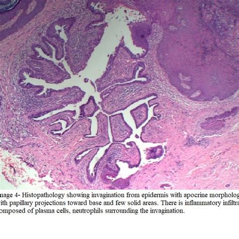 Preoperative Picture Of Patient Showing Multiple Verrucous Papules