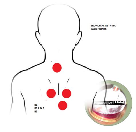 Bronchial Asthma Hijama Cupping Points Hijama Cupping Therapy