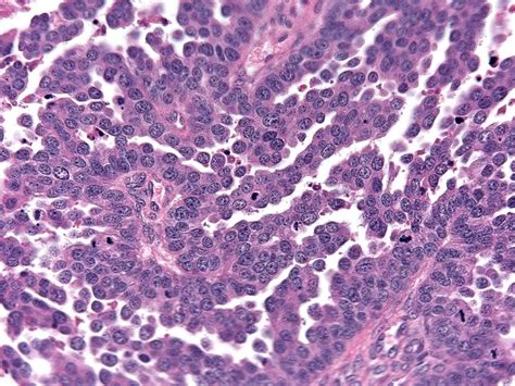 Pathology Outlines - High grade serous carcinoma