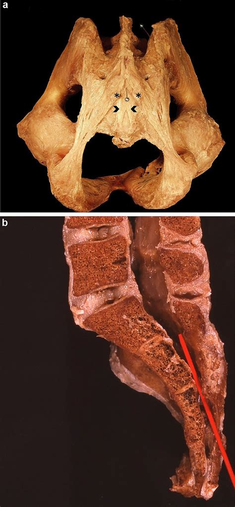 Bone–ligamentous anatomy of the sacral hiatus area. a Posteroinferior... | Download Scientific ...