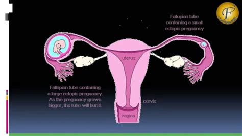 How To Prevent Ectopic Pregnancy Ii अस्थानिक गर्भावस्था Ii Details