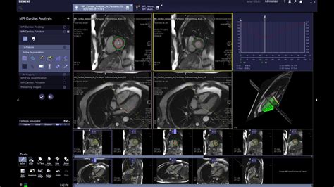 Syngo Via For MRI Siemens Healthineers