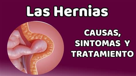 Las Hernias Causas Signos Y S Ntomas Diagn Stico Y Tratamiento Youtube