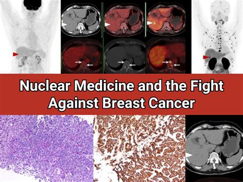 Advancing The Fight Against Breast Cancer How Nuclear Medicine Is