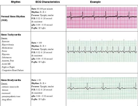 Ecg Acls Rhythms Cheat Sheet