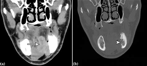 Coronal Soft Tissue A And Bone B Window Post Contrast Ct Images