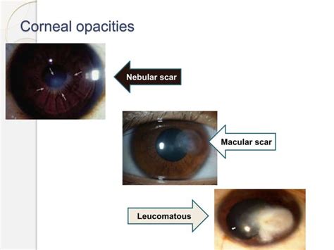 Cornea Physiology Ppt