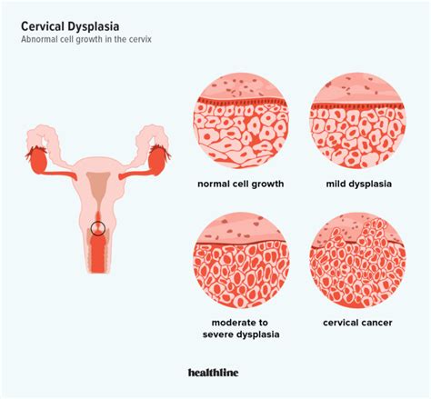 Understanding Cervical Dysplasia Causes And Symptoms Ask The Nurse