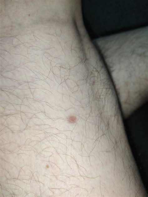 Small Red Bump Behind My Thigh Been There 2 Years What Could It Be Rdermatology