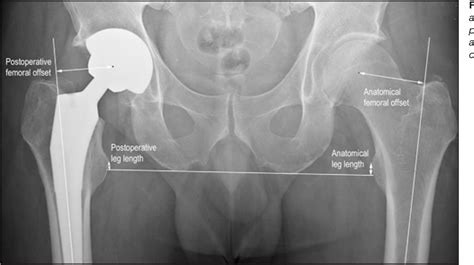 Figure From A Radiographic Comparison Of Femoral Offset After