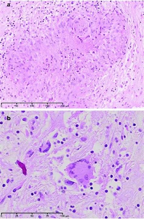 Photomicrograph Showing Necrosis Surrounded By Epithelioid Cells A Download Scientific