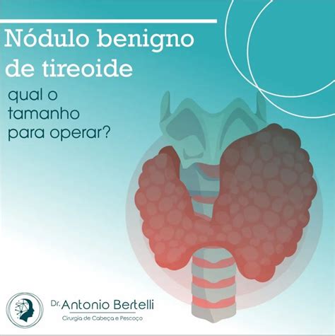 N Dulo Benigno De Tireoide