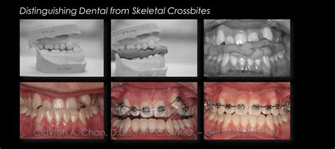 Orthodontics Psuedo Class Iii Maxillary Arch Correction With Gnm