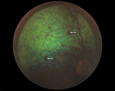 Plasma Cell Tumours In Dogs Multiple Myeloma Veterinary Practice