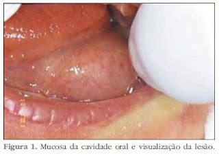 Patologia Oral Cisto Do Ducto Nasopalatino E Cisto Dermoide