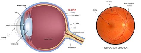 Cirurgia de Deslocamento de Retina em Blumenau Clínica de Olhos