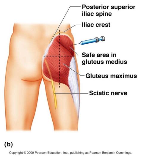 Best 25+ Intramuscular injection sites ideas on Pinterest | Im ...