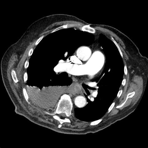 Hemothorax Due To Rib Fractures Image