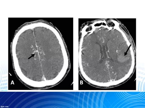 Dural Arteriovenous Fistula And Avm Ppt