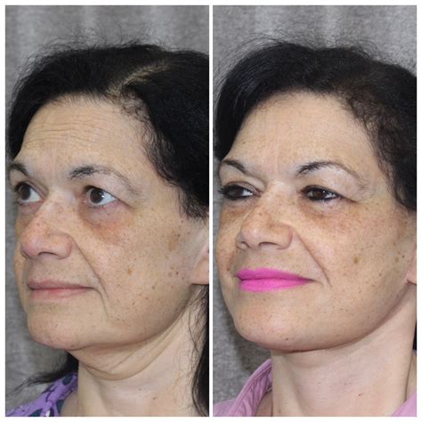 Best Neck Lift In Long Island Platysmaplasty By Dr Doshi