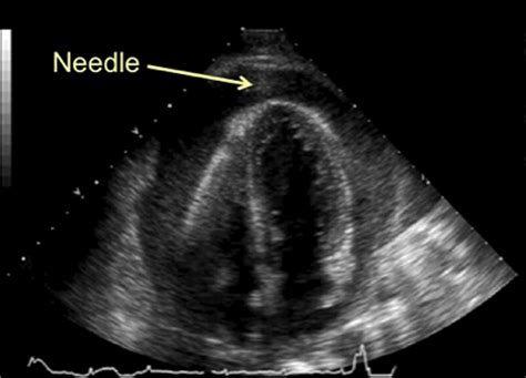 Ultrasound Guided Procedures In The Emergency Department—diagnostic And