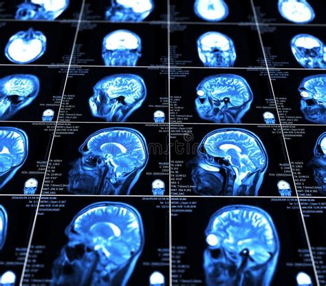 Magnetic Resonance Imaging Of The Brain Stock Image Image Of Magnetic