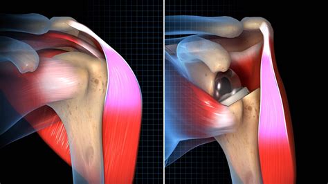 Equinoxe Reverse System Total Shoulder Arthroplasty Exactech