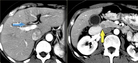 The Radiology Assistant Biliary Ducts Pathology