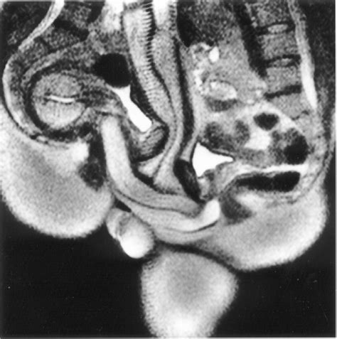 Mri Image Of The Anatomy Of Hetero Sexual Intercourse 1 Download Scientific Diagram