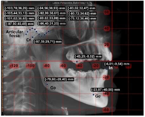 Lateral Cephalometric X Ray With The Mm Ruler On The Left The X Y Axes