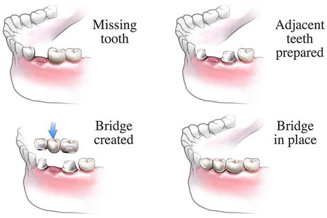 Dental Bridge Front Teeth