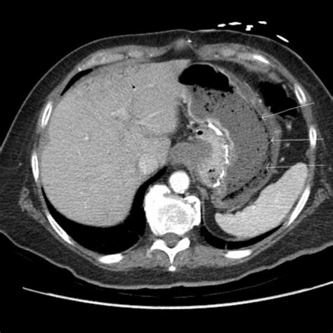 Computed Tomography Ct Of The Abdomen Showing Gastric Emphysema