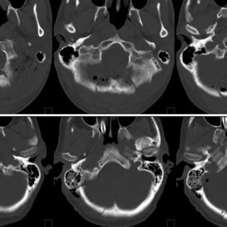 PDF Craniotomy Vs Craniectomy For Posterior Fossa Tumors A