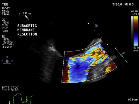 Echocardiographic Diagnosis Of A Subaortic Membrane Attached To The Free Edge Of The Right