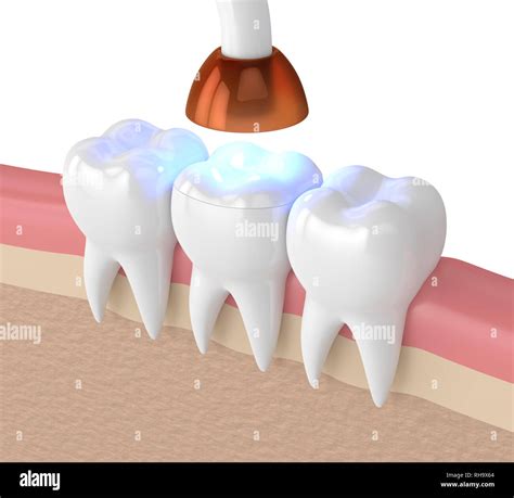 D Render Of Teeth With Dental Polymerization Lamp And Light Cured